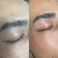 ヒゲ脱毛＋HBL（ハリウッドブロウリフト）