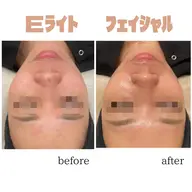 しみやしわ、毛穴開きが気になる方!肌質を改善しながらリフトアップ!🌟 【Eライト光フェイシャル2周】