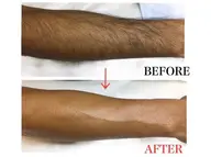 ボディワックス脱毛 ★両腕上下★