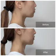 ミニモ限定！人気NO.1最強リフトアップ！サーマルフラクショナル