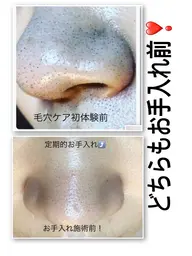 tete式毛穴エクストラクション