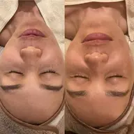 【高濃度炭酸ガスパック✨＋ベーシックフェイシャル90分ハンドケア付き¥9.900⇨8400