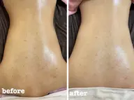 【背中ニキビ・シミなどが気になる方】背中上部をお試しでVCFリキッドプレゼント