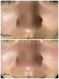 【近くで見られても自信ある肌へ】ポアリファインフェイシャル💎8000円→初回7000円✨