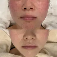 ２月限定価格🌿【赤み・ニキビケア】剥離ハーブピーリング＆顔リンパマッサージ¥22000→