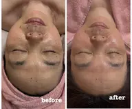 ハードタイプ（剥離あり）のハーブピーリング　アフターケアのスキンケア商品プレゼント