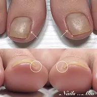 👣巻爪矯正ケアドイツ式B/Sブレイス親指1本30