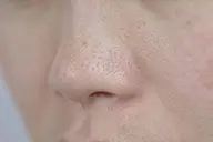 【毛穴ケア(小鼻/頬)】黒ずみ毛穴/開き毛穴にお悩みの方！毛穴集中エステ✨(ショルダーマッサージ付です♪)