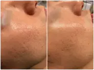 【🐰口コミを書いていただける方限定🐰】練習モデル割引🈹❣️【ニキビ跡や毛穴の開きを改善】サーマトリックス全顔＋首