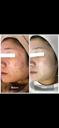 人気No.1👑✨💕ハイドラ＋ハーブピーリング剥離あり🌿毛穴黒ずみ　美白　シミ　ニキビ　ニキビ跡　クレーター　くすみ