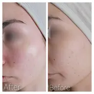 V.O.S肌再生トリートメント+ドライヘッドスパ付き