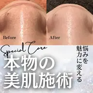 【20代に多い肌トラブル】ニキビケア・毛穴黒ずみが気になる方に