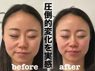 【美肌&小顔】花嫁準備に！ブライダル　美容鍼（100本）＋小顔矯正＋姿勢改善👰‍♀️