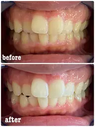 10代学生さん限定プラン💛(18歳まで)15分×2回照射🦷✨