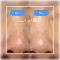 毛穴汚れスッキリコース