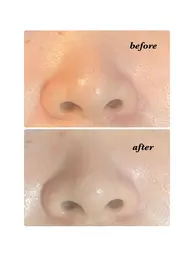 男性大人気❤️小鼻の黒ずみつるりん♡コース‼︎REVIのハーブピーリングとゴマージュで、黒ずみ、角質を取り除き、美鼻へ!