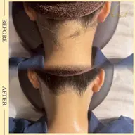 うなじの左右差が気になる【デザイン相談★】うなじ調整脱毛