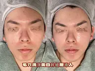 【メンズもOK、プレミア毛穴レス/陶肌ケア】★毛穴洗浄×光フェイシャル
