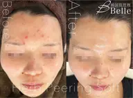 ハーブピーリング+アクネ菌殺菌