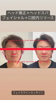 【丸顔,面長、エラ張り】骨格から変える小顔矯正＋ヘッド矯正＋ハイパーナイフ 45分　オプション,デンバリブラシプレゼント