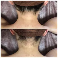 《パーツ脱毛》うなじ