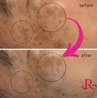 【REVIマシン】光フェイシャルでトラブル肌改善☆鎮静パックプレゼント付🎁