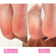 《 フット角質ケア 》 フットバス、角質除去、磨き上げ、保湿でつるつるな足裏に🫧