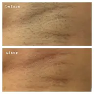 ご新規限定価格✨レディース脱毛❇️ワキ シェービング付き