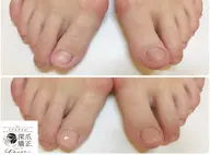 【深爪矯正★男性フット】お試し1回体験