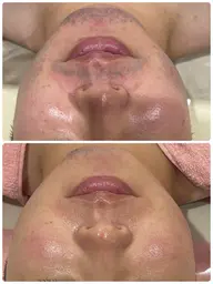 メンズ👱‍♂️💙大特価キャンペーン☆【頬～首までしっかりヒゲ脱毛】