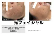 光フェイシャル