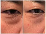 目の下のたるみケア【レッドショット】