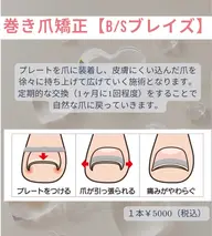 巻き爪矯正(1本)