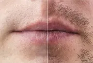 【メンズ脱毛】ピンポイント1本処理の1回完了脱毛/1本¥200×20本¥4000→¥999