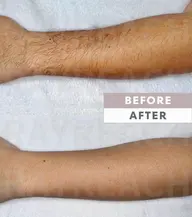 メンズ脱毛　両腕！