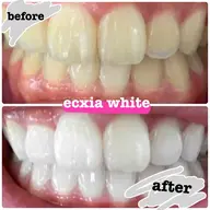 【人気No.1】スペシャルホワイトニング★60分真っ白お約束→¥14,500→¥11,000！