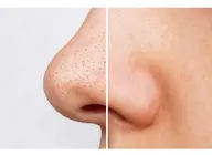 【特別価格】ごっそり毛穴洗浄