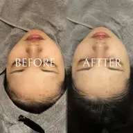 ［モニター限定📸］🔥minimo限定🔥50%OFF　ハーブピーリング＋LDM