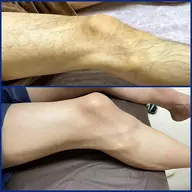 Tシャツ短パンの着こなしレベルを上げる!腕&脚脱毛 ¥1,980