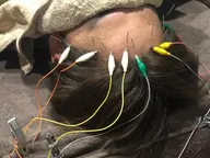 メンズ薄毛お悩み頭皮鍼【日中限定キャンペーン】✨特別価格1回のみ(2回目からもお得)優先予約枠確保