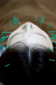 【#アオハル】 学割U24【4000円～】美容鍼20分￥10000円～→￥3000円～