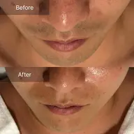 【都度払い】メンズ ヒゲ脱毛 都度払い ¥18,000‐