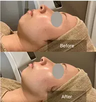 【初回限定】マイクロ波温熱オンリフト1部位（引き締め）