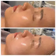 【ハーブピーリング2ｇIPSコース】ニキビ/毛穴/くすみ/シミ/たるみ/どんな肌トラブルも◎