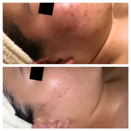 【初回限定】ニキビが気になる方へ！毛穴&皮脂バランスケア体験