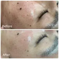 大人気王道🫅メニュー【毛穴洗浄✖️美白鎮静マスク】毛穴の黒ずみ＆開き＆角栓に！今だけ限定この価格！¥3980