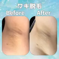 女性限定！！！　全身脱毛