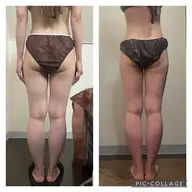 モデル様募集🌿ハイパーナイフ✖️脚痩せ&ヒップアップ⤴️