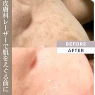 最高級《15万本の針》VOSサロンケア💉✨毛穴、しみ、しわ、ニキビ、たるみ、肌を変える60分¥11000