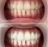 セルフホワイトニング【20分照射】